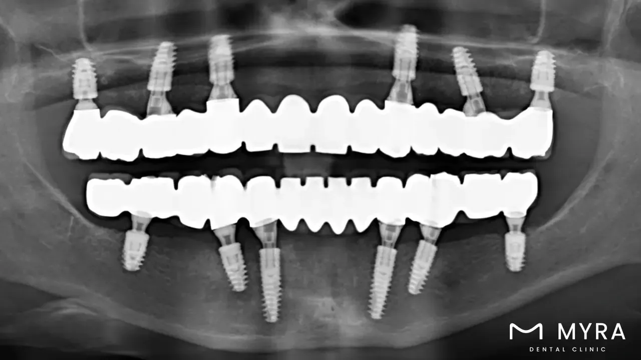 3. Full Mouth Implant.webp